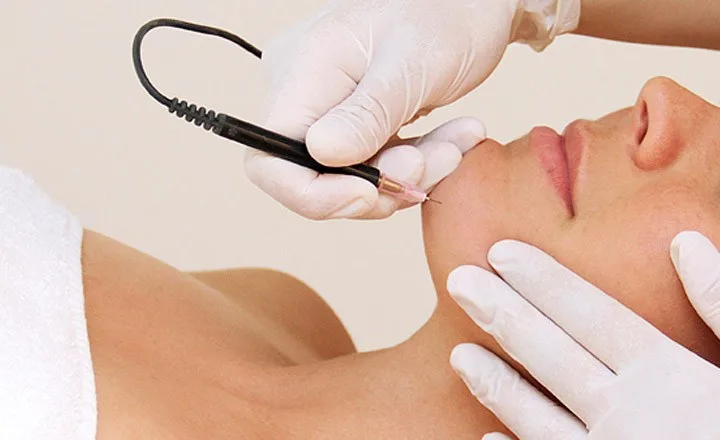 Electrolysis permanent hair removal on the face at Izba Spa Wimbledon